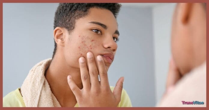 transgender acne